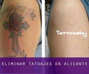 Eliminar tatuajes en Alicante