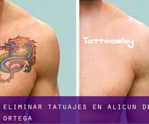 Eliminar tatuajes en Alicún de Ortega