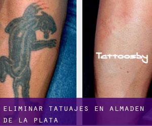 Eliminar tatuajes en Almadén de la Plata