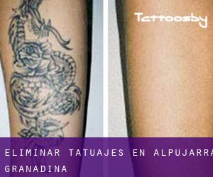 Eliminar tatuajes en Alpujarra Granadina