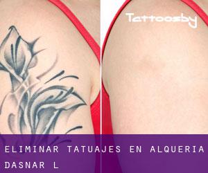 Eliminar tatuajes en Alqueria d'Asnar (l')
