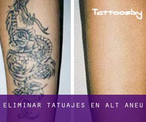 Eliminar tatuajes en Alt Àneu