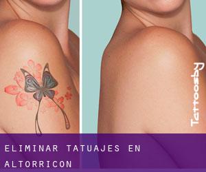 Eliminar tatuajes en Altorricón