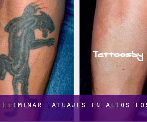 Eliminar tatuajes en Altos (Los)