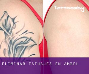 Eliminar tatuajes en Ambel
