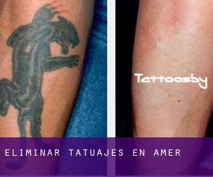 Eliminar tatuajes en Amer
