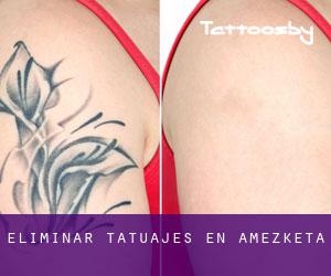 Eliminar tatuajes en Amezketa