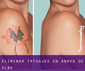 Eliminar tatuajes en Anaya de Alba