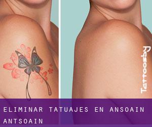 Eliminar tatuajes en Ansoáin / Antsoain