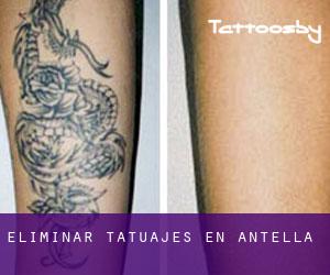 Eliminar tatuajes en Antella