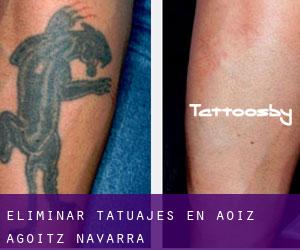 Eliminar tatuajes en Aoiz / Agoitz (Navarra)