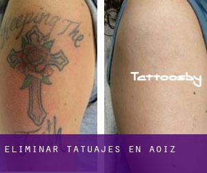 Eliminar tatuajes en Aoiz