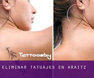 Eliminar tatuajes en Araitz