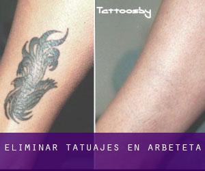 Eliminar tatuajes en Arbeteta