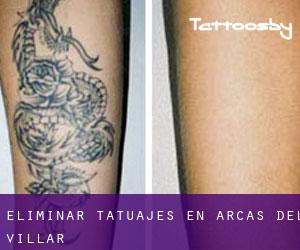 Eliminar tatuajes en Arcas del Villar