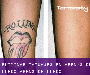 Eliminar tatuajes en Arenys de Lledó / Arens de Lledó