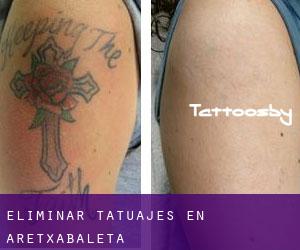 Eliminar tatuajes en Aretxabaleta
