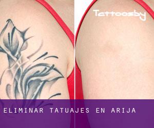 Eliminar tatuajes en Arija