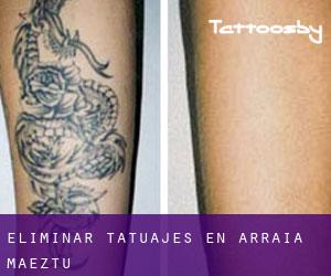 Eliminar tatuajes en Arraia-Maeztu