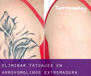 Eliminar tatuajes en Arroyomolinos (Extremadura)