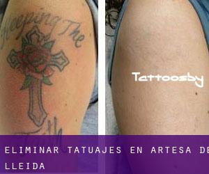 Eliminar tatuajes en Artesa de Lleida