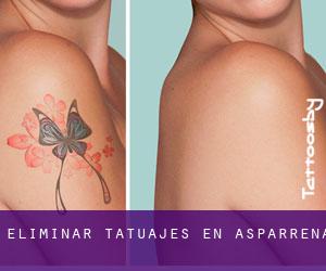 Eliminar tatuajes en Asparrena