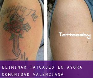 Eliminar tatuajes en Ayora (Comunidad Valenciana)
