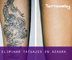 Eliminar tatuajes en Azagra