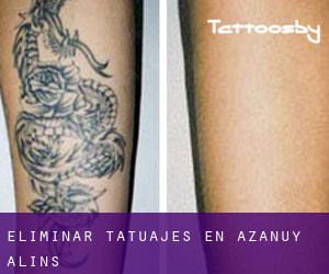Eliminar tatuajes en Azanuy-Alins