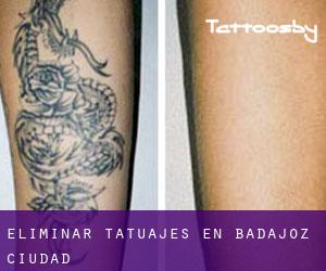 Eliminar tatuajes en Badajoz (Ciudad)