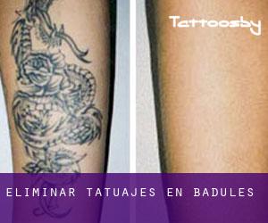 Eliminar tatuajes en Badules