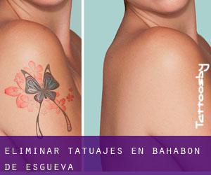 Eliminar tatuajes en Bahabón de Esgueva
