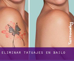 Eliminar tatuajes en Bailo