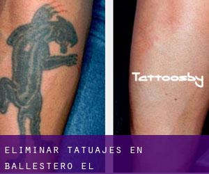 Eliminar tatuajes en Ballestero (El)