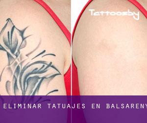 Eliminar tatuajes en Balsareny