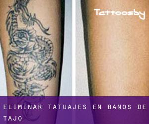 Eliminar tatuajes en Baños de Tajo