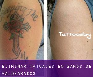 Eliminar tatuajes en Baños de Valdearados