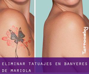 Eliminar tatuajes en Banyeres de Mariola