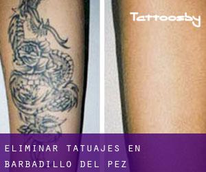 Eliminar tatuajes en Barbadillo del Pez