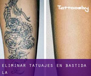 Eliminar tatuajes en Bastida (La)