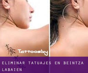 Eliminar tatuajes en Beintza-Labaien