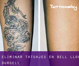 Eliminar tatuajes en Bell-lloc d'Urgell