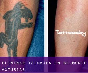 Eliminar tatuajes en Belmonte (Asturias)