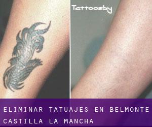 Eliminar tatuajes en Belmonte (Castilla-La Mancha)