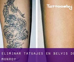 Eliminar tatuajes en Belvís de Monroy