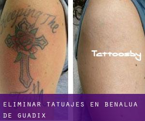 Eliminar tatuajes en Benalúa de Guadix