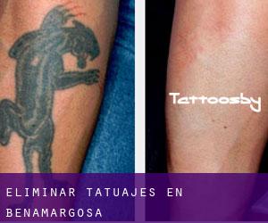 Eliminar tatuajes en Benamargosa
