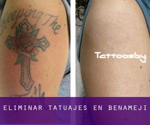 Eliminar tatuajes en Benamejí