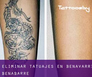 Eliminar tatuajes en Benavarri / Benabarre