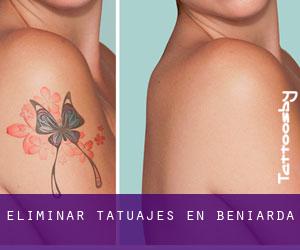 Eliminar tatuajes en Beniardá